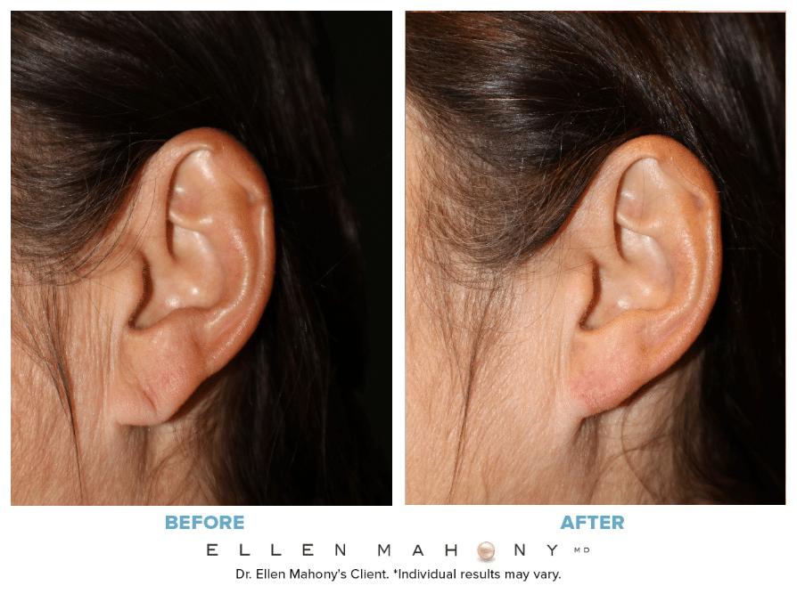 Before and After Image: Case #14899 - left-side