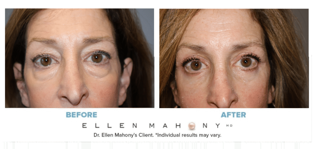 Before and After Image: Case #15182 - front