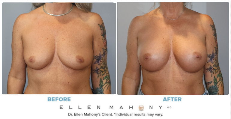 Before and After Image: Case #15304 - front