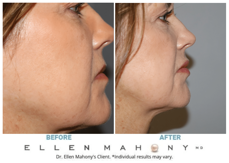 Before and After Image: Case #11899 - right-side