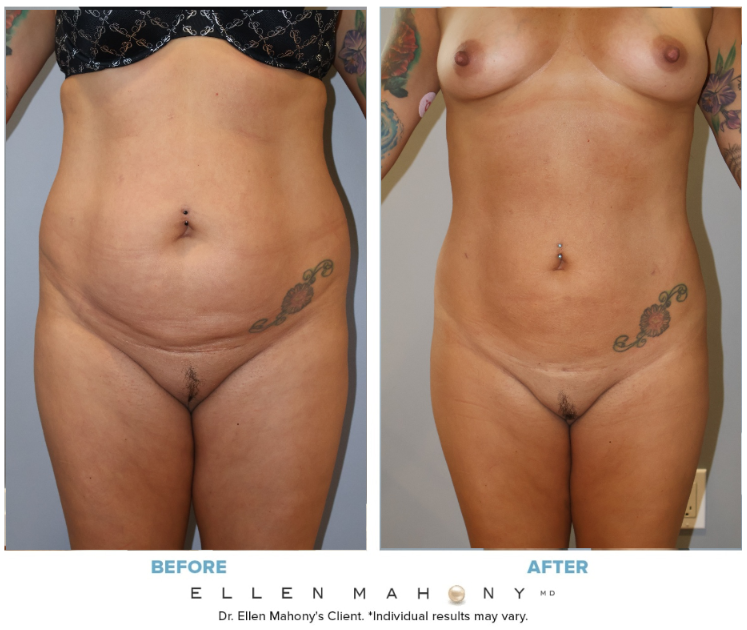Before and After Image: Case #14734 - front