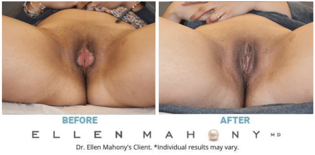 Before and After Image: Case #15140 - front