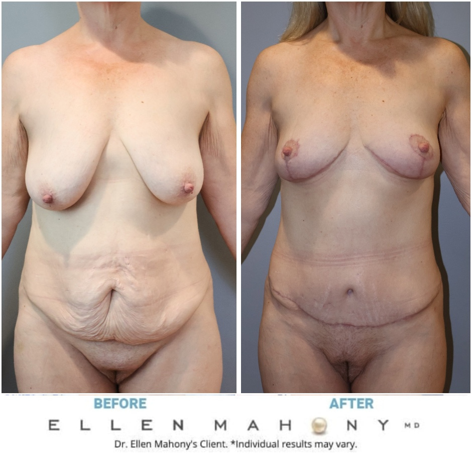 Before and After Image: Case #14550 - front