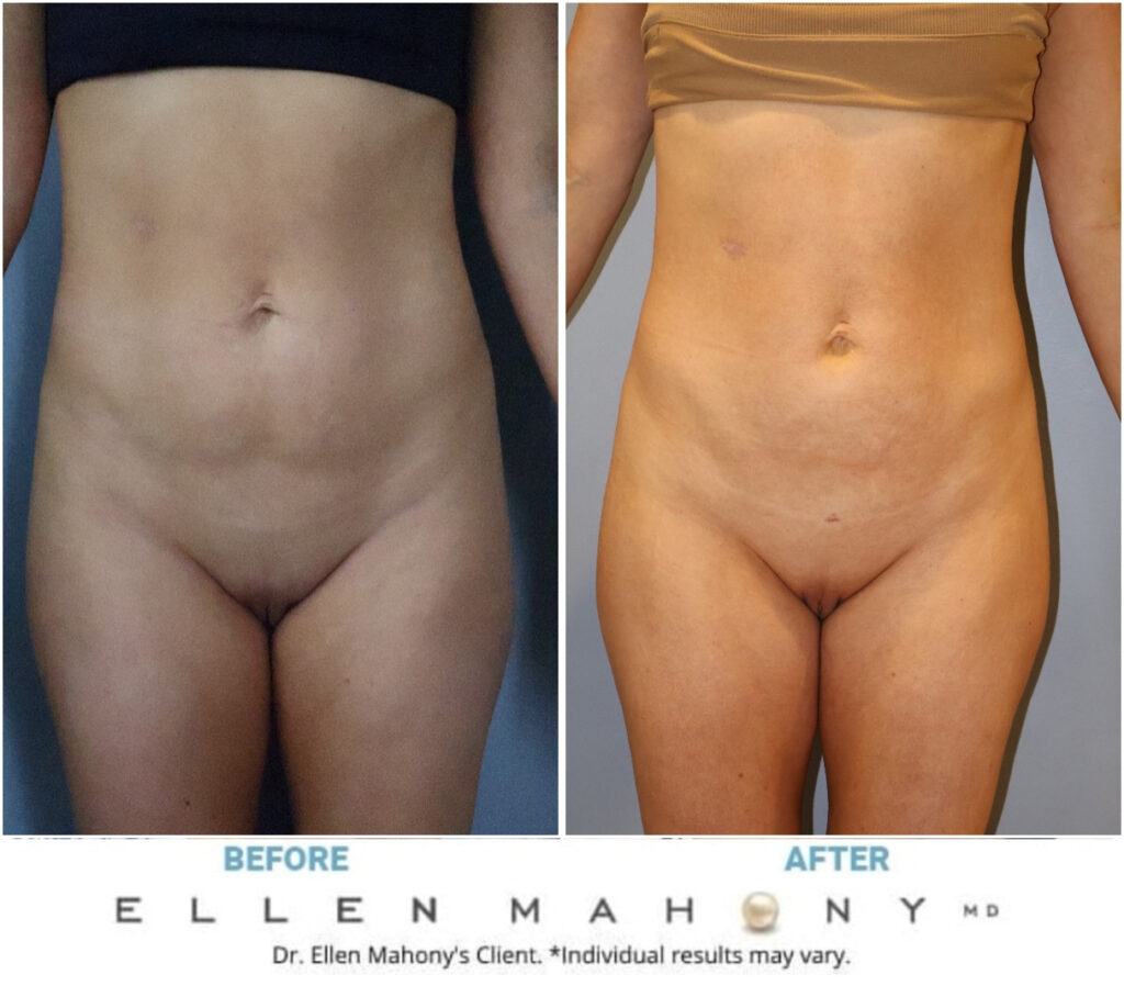 Before and After Image: Case #14708 - front