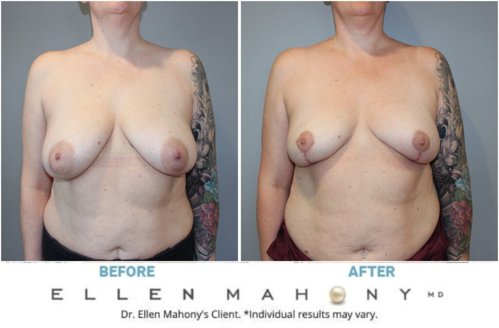 Before and After Image: Case #13137 - front