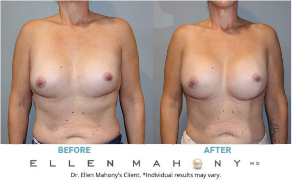 Before and After Image: Case #12016 - front