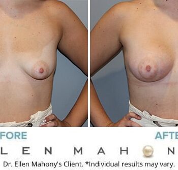 Mastopexy (Breast Lift) 38D to 38C - Conkright Aesthetics