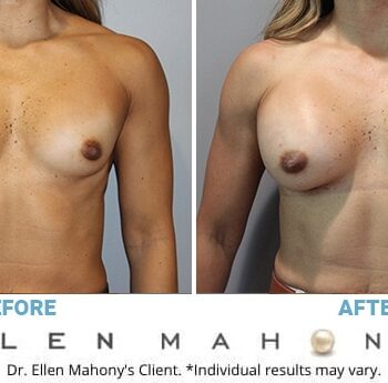 26 YRS 5'1 120lbs 34c! [BREAST AUGMENTATION] - Review - RealSelf