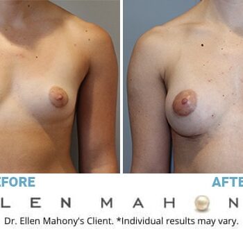 Case Study: Saline Breast Augmentation in Thin Women - Explore Plastic  Surgery