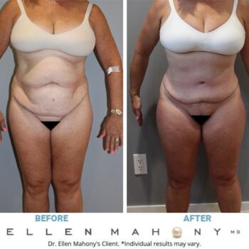 Mons Pubis Lift Case #7390 - Ellen A. Mahony, MD