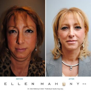 Face Lift/Neck Lift Westport CT | Dr. Ellen Mahony