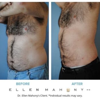 Liposuction for Men Westport CT | Dr. Ellen Mahony