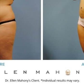 Liposuction Westport CT | Dr. Ellen Mahony
