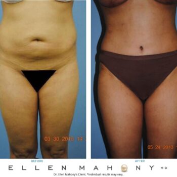 Liposuction Westport CT | Dr. Ellen Mahony