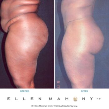 Tummy Tuck Westport CT | Dr. Ellen Mahony