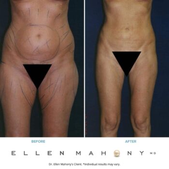 Liposuction Westport CT | Dr. Ellen Mahony