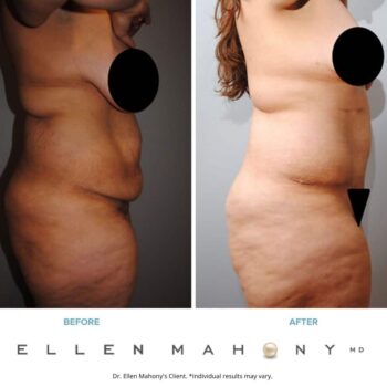 Tummy Tuck | Westport CT | Dr. Ellen Mahony