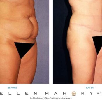 Vertical Scar Tummy Tuck | Westport CT | Dr. Ellen Mahony