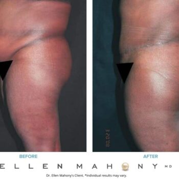 Tummy Tuck | Westport CT | Dr. Ellen Mahony