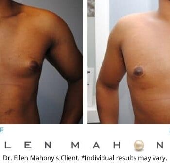 Male Breast Reduction Westport CT | Dr. Ellen Mahony