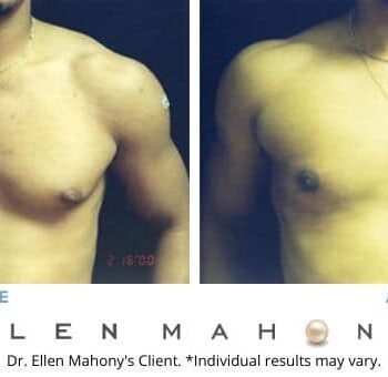 Male Breast Reduction Westport CT | Dr. Ellen Mahony