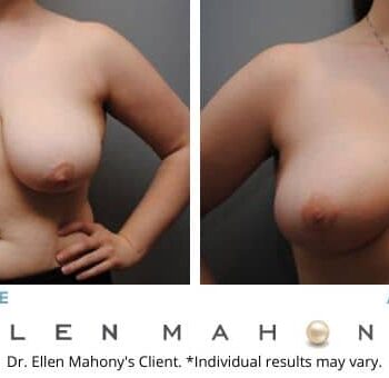 Breast Reduction Westport CT | Dr. Ellen Mahony