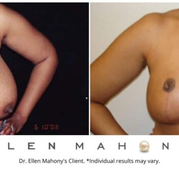 Breast Reduction Westport CT | Dr. Ellen Mahony