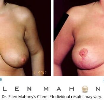 Breast Reduction Westport CT | Dr. Ellen Mahony