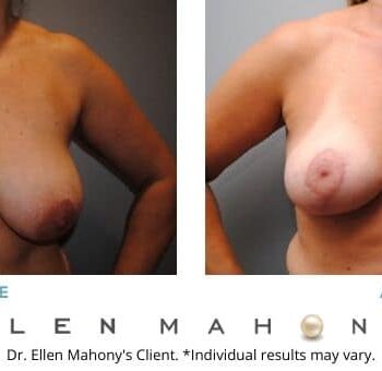 Breast Lift | Westport CT | Dr. Ellen Mahony