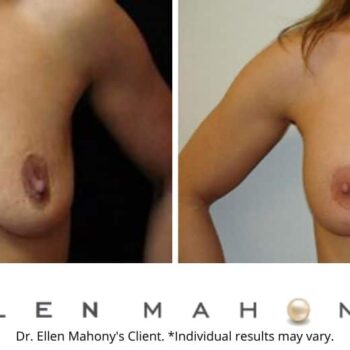 Breast Lift Westport CT | Dr. Ellen Mahony