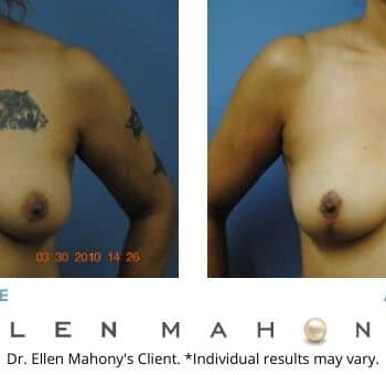 Breast Lift Westport CT | Dr. Ellen Mahony