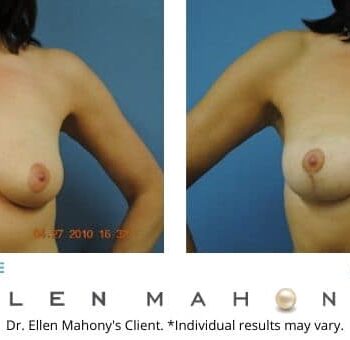 Breast Lift Surgeon Westport CT
