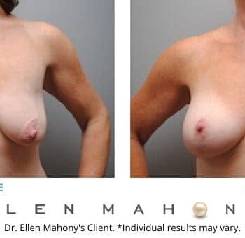 Breast Augmentation and Lift | Westport CT | Dr. Ellen Mahony