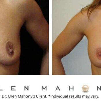 Breast Augmentation and Lift Westport CT | Dr. Ellen Mahony
