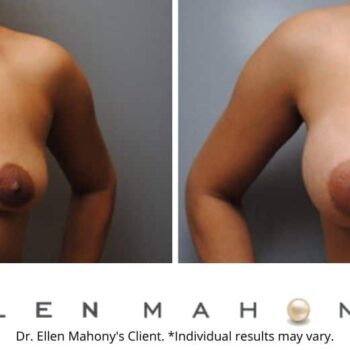 Corrective Breast Surgery – Asymmetry | Westport CT | Dr. Ellen Mahony