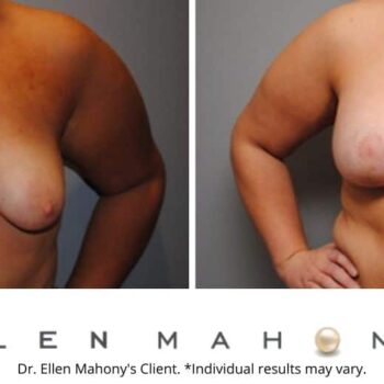 Breast Augmentation and Lift Westport CT | Dr. Ellen Mahony