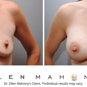 Breast Augmentation | Westport CT | Dr. Ellen Mahony