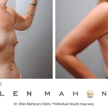 Breast Augmentation | Westport CT | Dr. Ellen Mahony