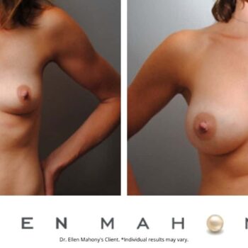 Breast Augmentation | Westport CT | Dr. Ellen Mahony