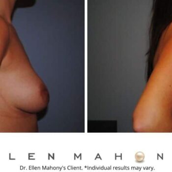Breast Augmentation | Westport CT | Dr. Ellen Mahony
