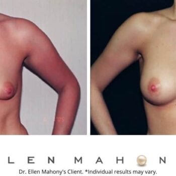 Breast Augmentation | Westport CT | Dr. Ellen Mahony