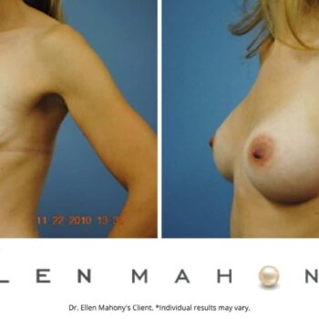 Breast Augmentation | Westport CT | Dr. Ellen Mahony
