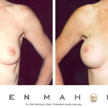 Breast Augmentation | Westport CT | Dr. Ellen Mahony