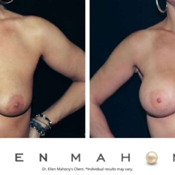 Breast Augmentation | Westport CT | Dr. Ellen Mahony