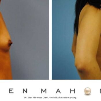 Breast Augmentation | Westport CT | Dr. Ellen Mahony
