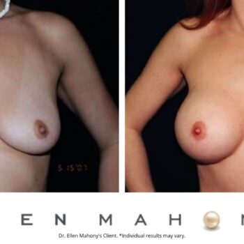 Breast Augmentation | Westport CT | Dr. Ellen Mahony