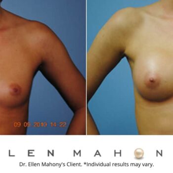 Breast Augmentation | Westport CT | Dr. Ellen Mahony
