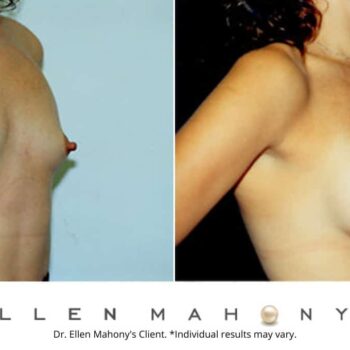 Breast Augmentation | Westport CT | Dr. Ellen Mahony