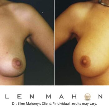 Breast Augmentation | Westport CT | Dr. Ellen Mahony