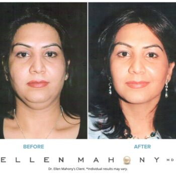 Skin Resurfacing | Westport CT | Dr. Ellen Mahony